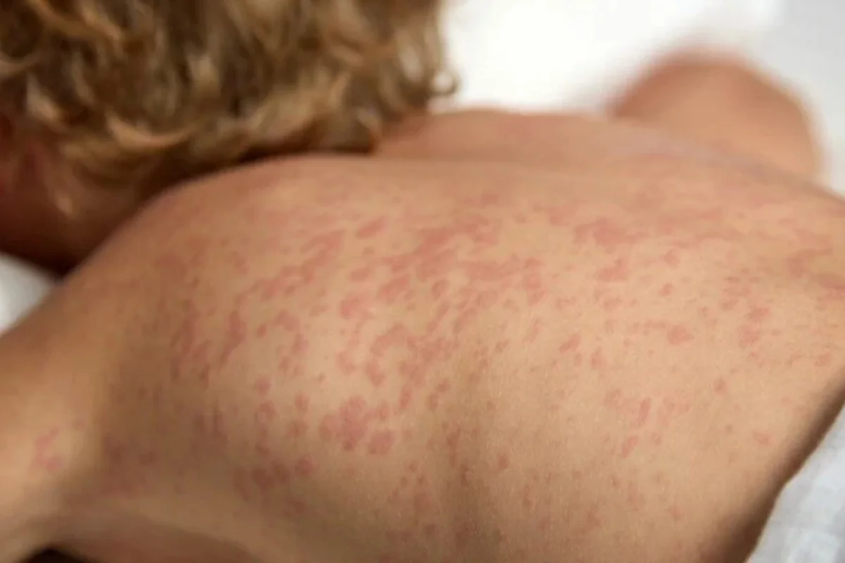 Bogotá confirma caso importado de sarampión en un viajero procedente de México - Foto: Redes sociales